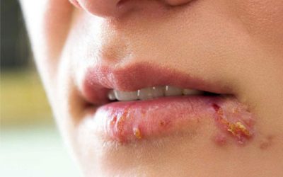 Sùi mào gà ở miệng là bệnh gì? Phương pháp điều trị dứt điểm