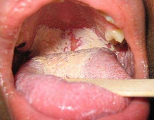 Dấu hiệu bệnh lậu ở miệng và họng