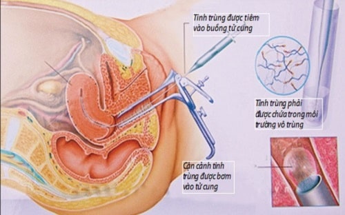 Phương pháp bơm tinh trùng vào tử cung (IUI)