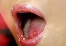 bệnh giang mai trong miệng 